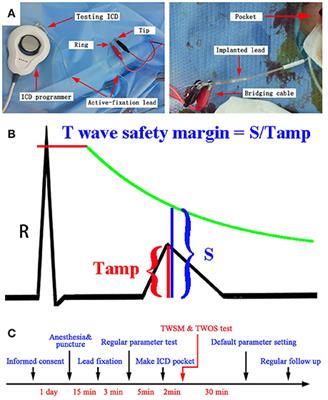 T Wave Safety Margin during the Process of ICD Implantation As a Novel Predictor of T Wave Oversensing